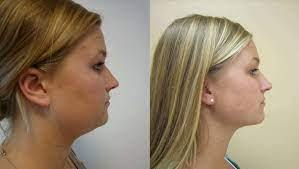 Neck Lift