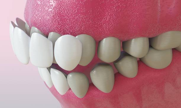 istockphoto 1169381226 Porcelain Veneers