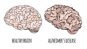 Alzheimer